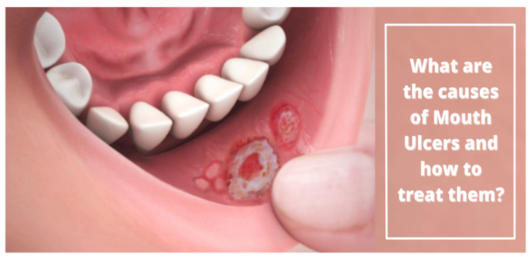 What Are The Causes Of Mouth Ulcers And How To Treat Them 