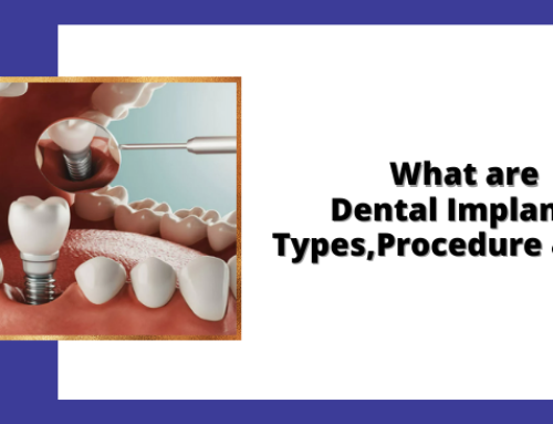 What are Dental Implants? Types, Procedures, Cost and More…