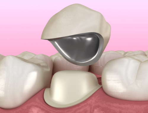 Tooth preparation guidelines for PFM crowns