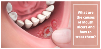 Mouth Ulcers: Annoying but Temporary. Get Relief Now!