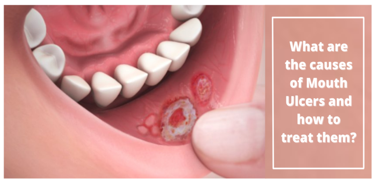 What are the causes of Mouth Ulcers and how to treat them?