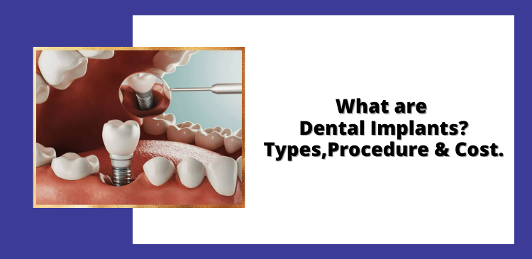 What are dental Implants