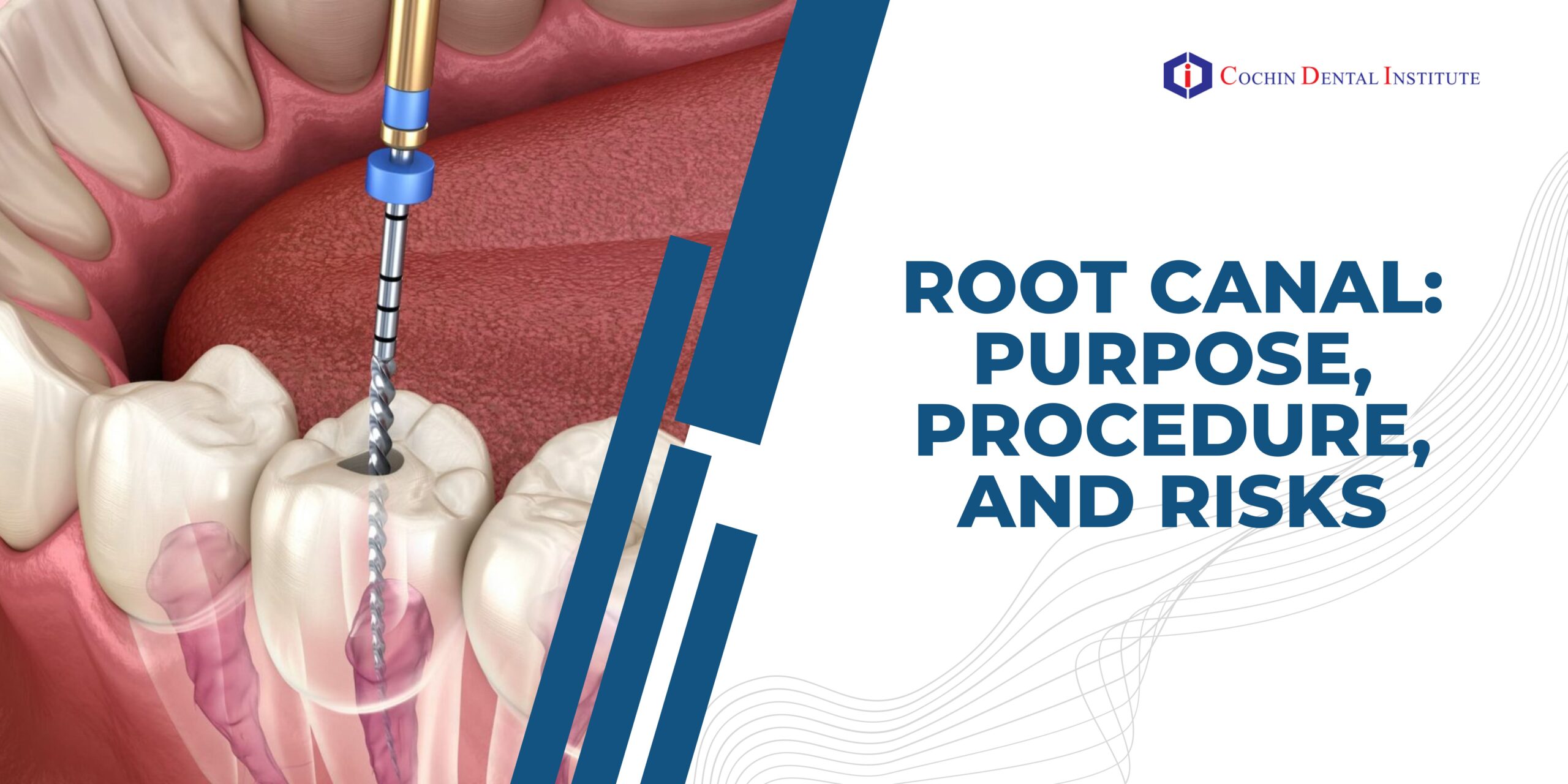 root canal: purpose, procedure and risks
