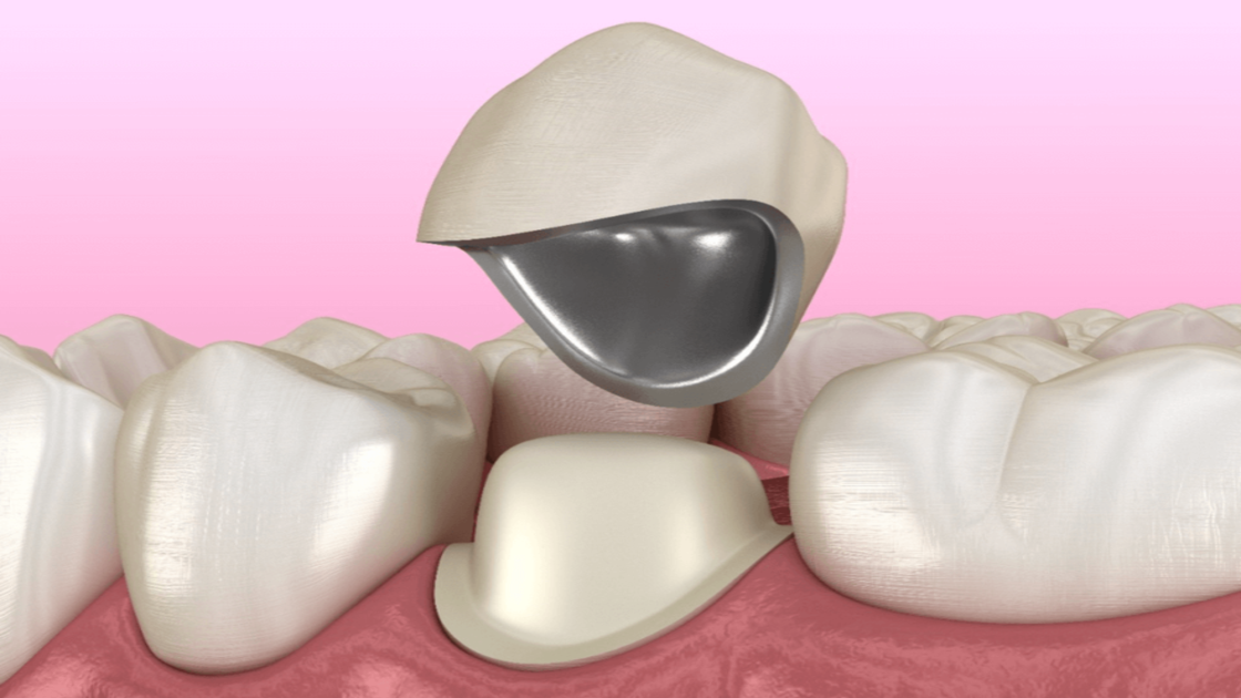 Tooth preparation guidelines for PFM crowns