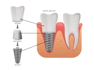 Dental Prosthetics